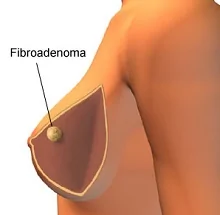 Фиброаденома молочной железы: симптомы, диагностика и лечение в ФНКЦ ФМБА
